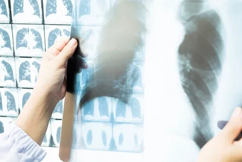 Amerikan Kanseri Derneği Açıkladı; Akciğer Kanserinde Tarama Yaşı Düştü