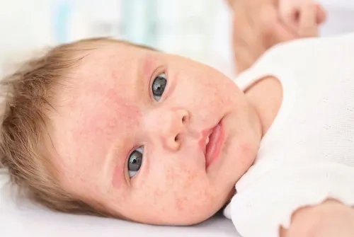 The Most Common Skin Rashes in Newborns