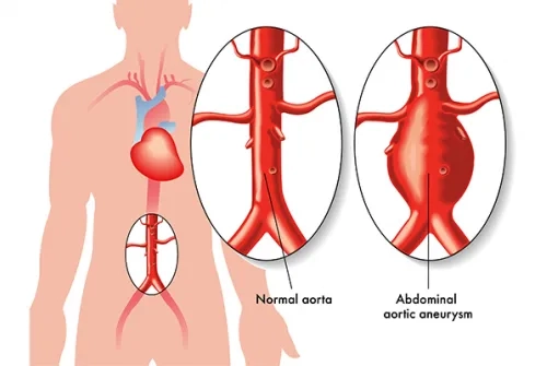 What is an Aortic Aneurysm? How is it treated?"